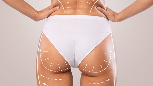 Non Surgical Butt Lift