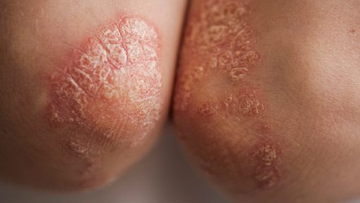 Psoriasis