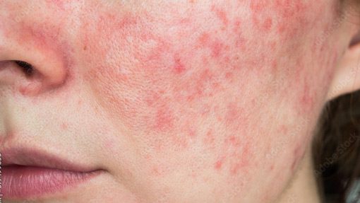 Rosacea