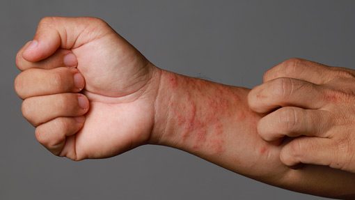 Eczema